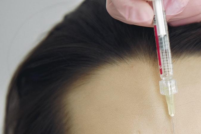 tratamiento con bòtox