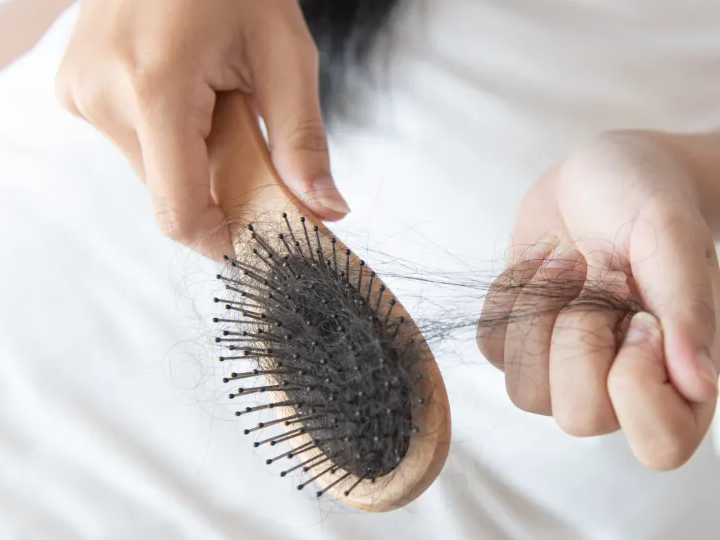 alopecia caida cabello shutterstock