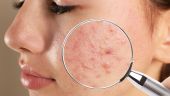 pieles con acné tratamientos