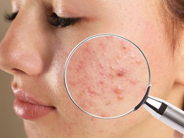 pieles con acné tratamientos