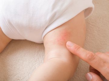 bebé con alergia en la piel